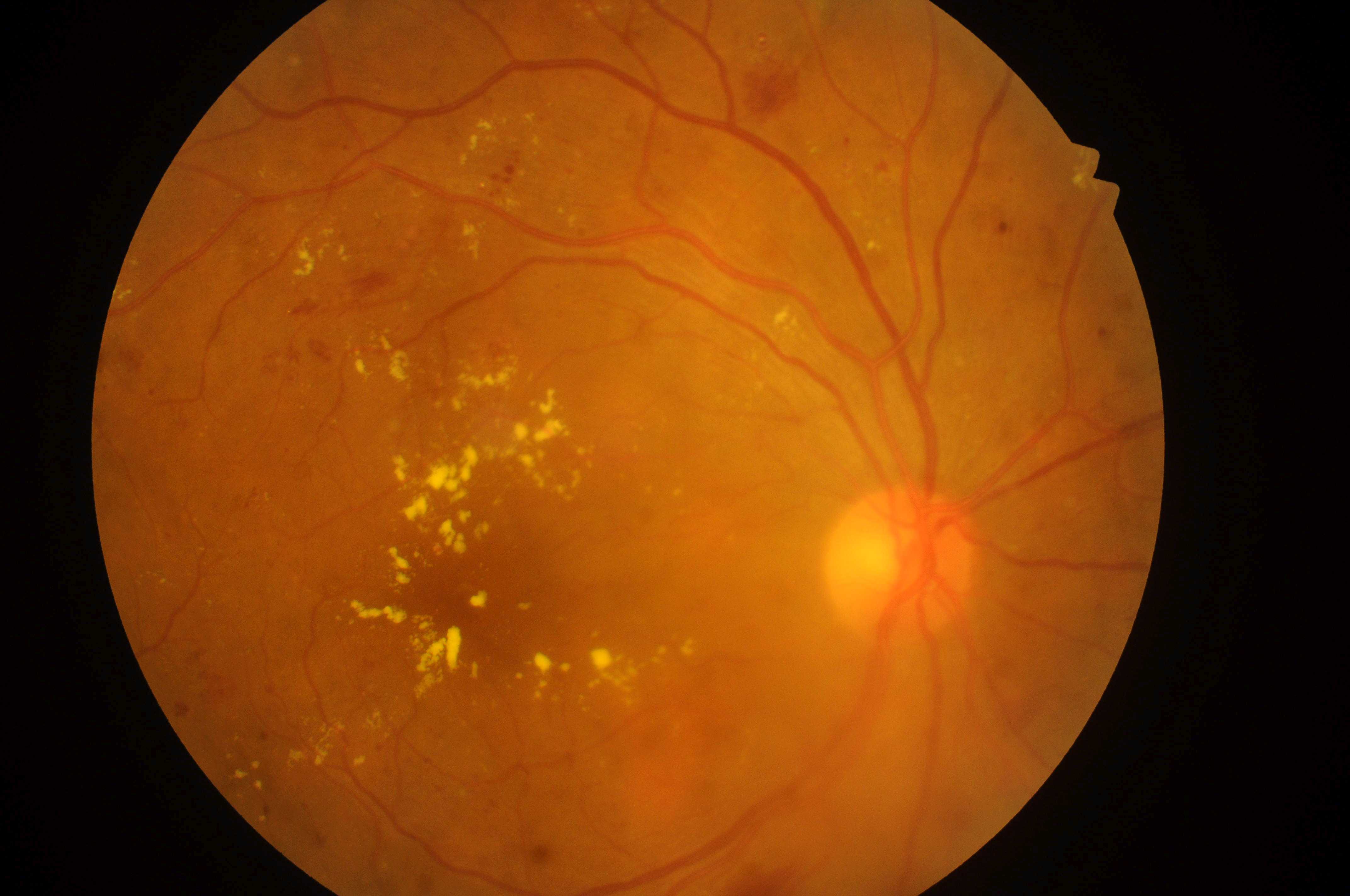 Fundus screening research image; illustrative of the modality