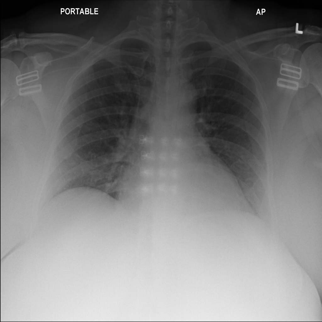 Chest X-ray research image; illustrative of the modality